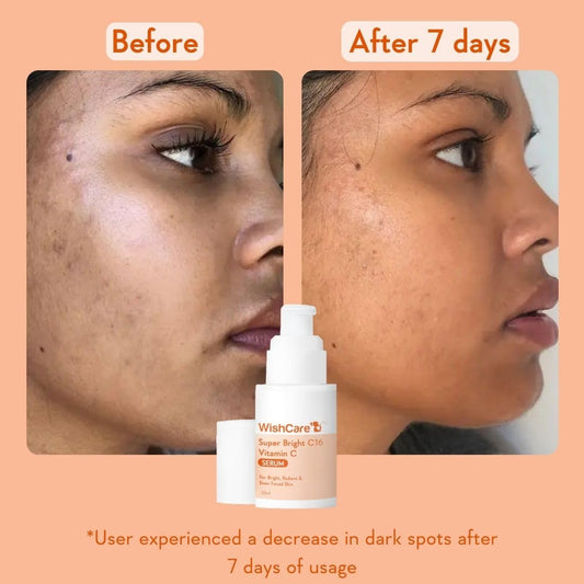 WishCare Super Bright C16 10% Vitamin C Serum For Glowing Skin | With 10% Vitamin C, Niacinamide & Kojic Acid | Face Serum For Women & Men | Reduces Pigmentation & Dark Spots | For Oily Skin, Dry & Combination Skin | 30ml