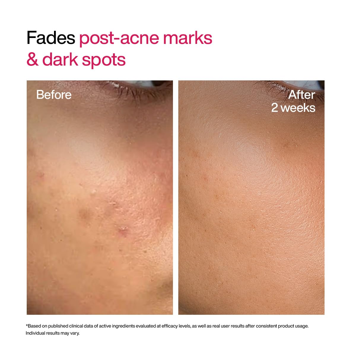 WishCare Advanced Dark Spot Correcting Serum - TXA Shot | 10% Niacinamide Face Serum For Pigmentation and Dark Spot | With 2% Alpha Arbutin & TXA for Glowing Skin | 10ml