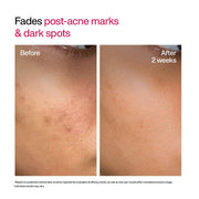 WishCare Advanced Dark Spot Correcting Serum - TXA Shot | 10% Niacinamide Face Serum For Pigmentation and Dark Spot | With 2% Alpha Arbutin & TXA for Glowing Skin | 10ml