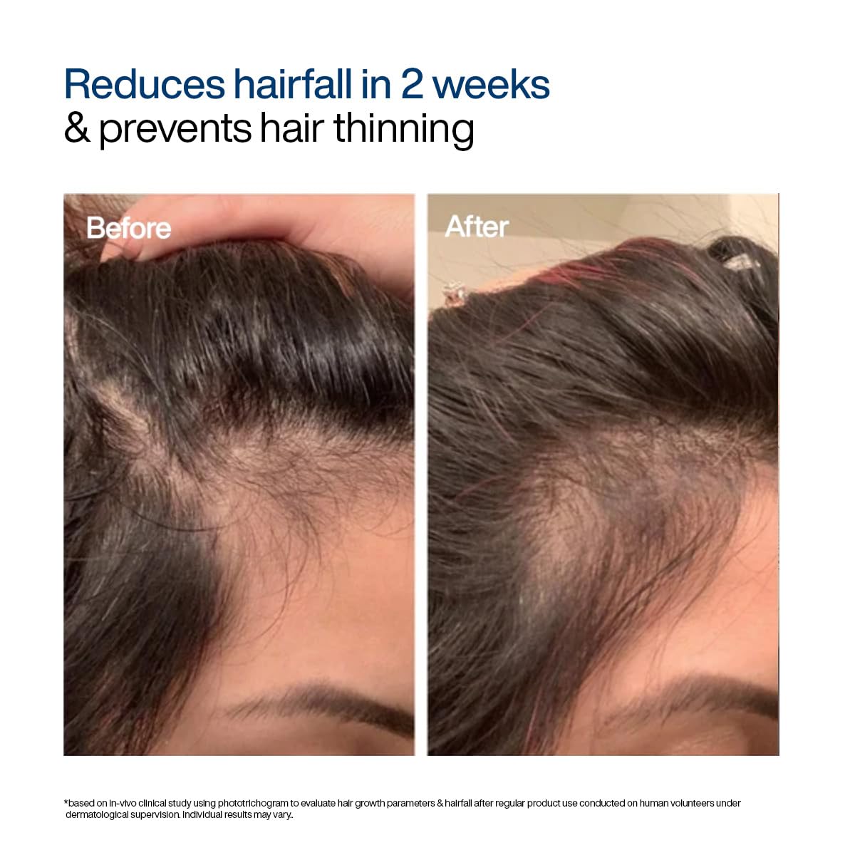 WishCare Advanced Foaming Hair Growth Serum- Redensyl, Anagain, Baicapil, Caffeine, Biotin & Rice PDRN - Advanced Serum Foam for Hair Fall Control & Hair Growth 50g