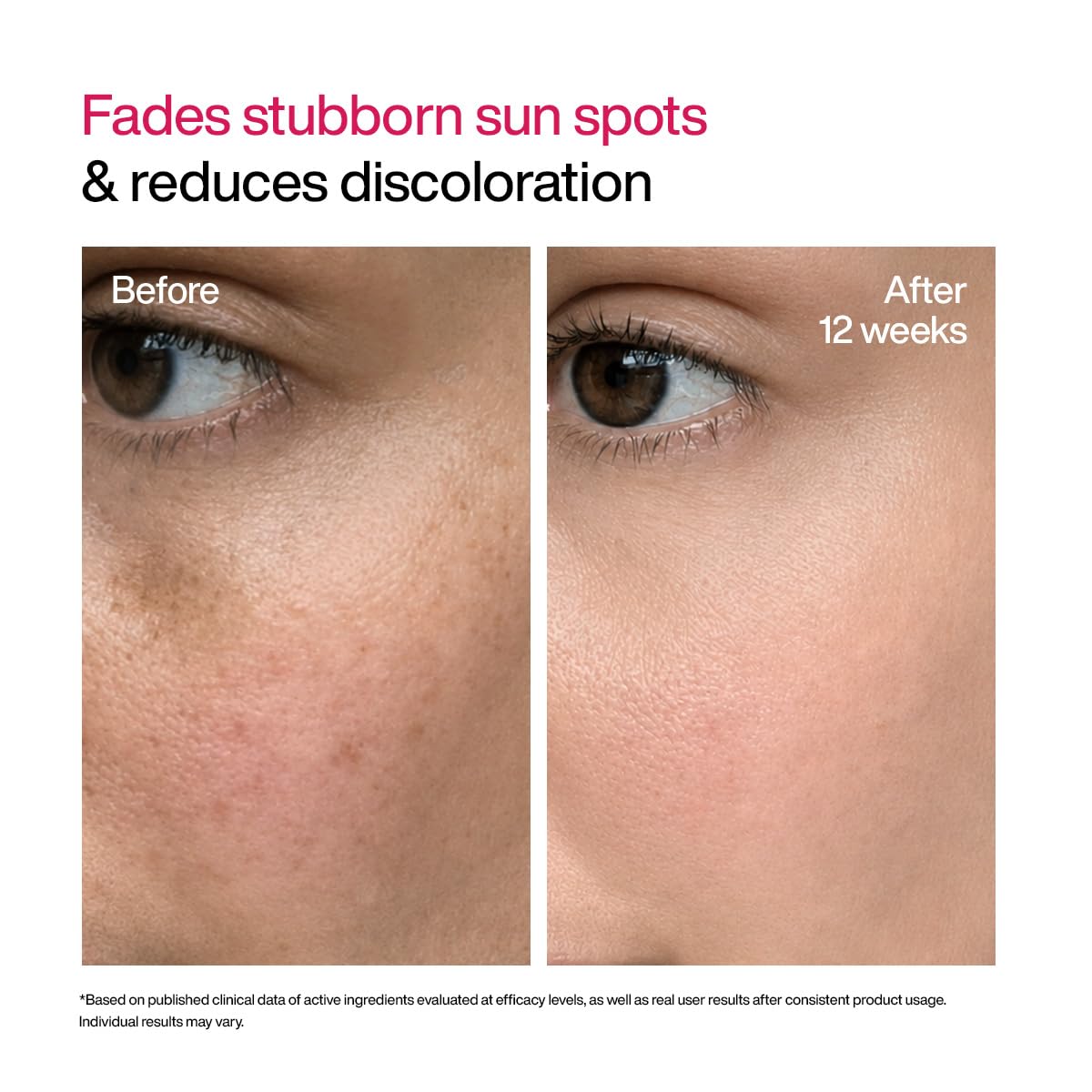 WishCare Advanced Dark Spot Correcting Serum - TXA Shot | 10% Niacinamide Face Serum For Pigmentation and Dark Spot | With 2% Alpha Arbutin & TXA for Glowing Skin | 10ml