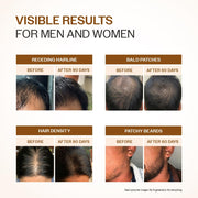 Bare Anatomy Advanced Hair Growth Serum | 3% Redensyl, 4% Anagain, 3% Baicapil, 1% Capilia Longa, Rosemary, Biotin & Rice Extract | Hairfall control & Hair Density | Women & Men | 30ml