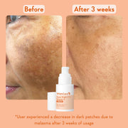 WishCare Super Bright C16 10% Vitamin C Serum For Glowing Skin | With 10% Vitamin C, Niacinamide & Kojic Acid | Face Serum For Women & Men | Reduces Pigmentation & Dark Spots | For Oily Skin, Dry & Combination Skin | 30ml