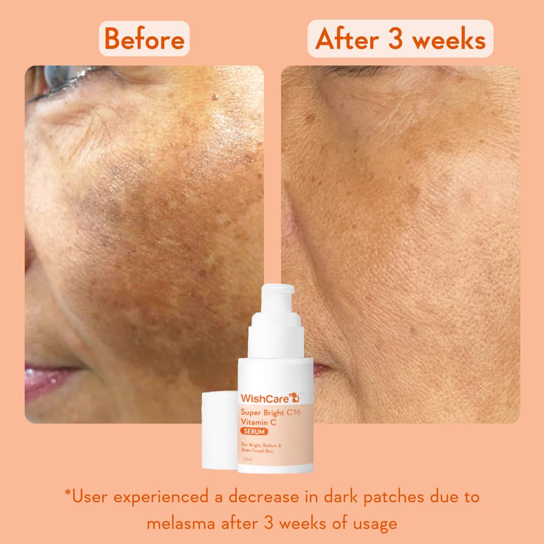 WishCare Super Bright C16 10% Vitamin C Serum For Glowing Skin | With 10% Vitamin C, Niacinamide & Kojic Acid | Face Serum For Women & Men | Reduces Pigmentation & Dark Spots | For Oily Skin, Dry & Combination Skin | 30ml