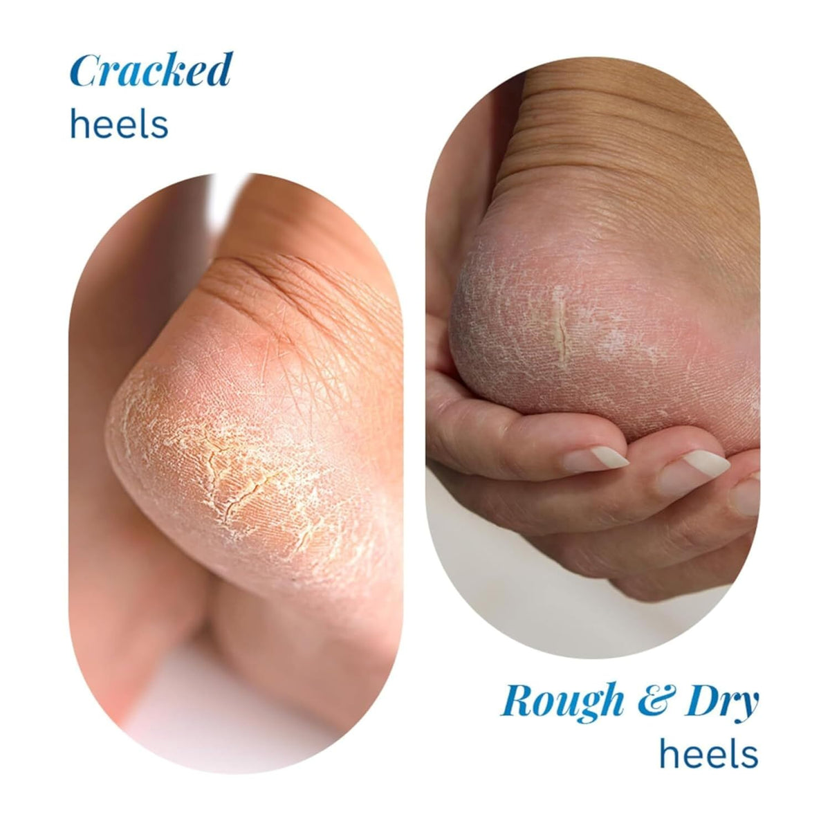 Be Bodywise 20% Urea Foot Cream Roll On 75ml | For Dry & Cracked Heels | With 2% Lactic Acid, Vitamin E & Olive Oil | Helps Moisturise and Repair Cracked Heels