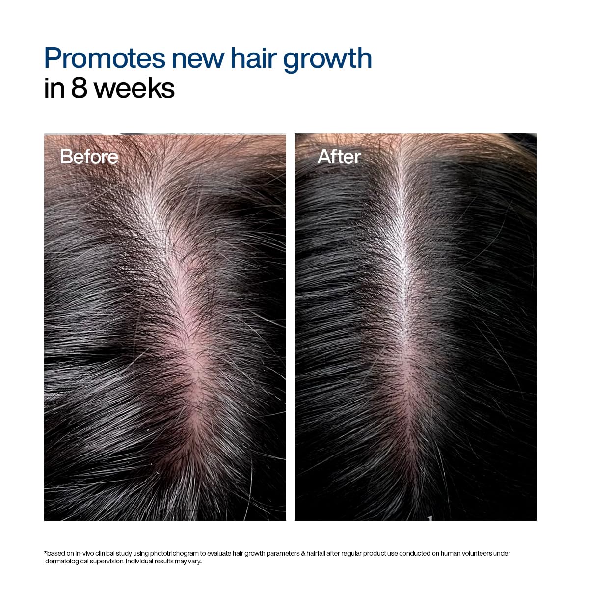 WishCare Hair Growth Serum Roll On For Scalp | 94% Saw New Hair Growth | Redensyl & Rosemary Oil | 100% Saw Hairfall Reduction | In-Vivo Tested | For Men & Women | 10ml