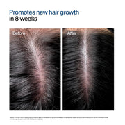 WishCare Hair Growth Serum Roll On For Scalp | 94% Saw New Hair Growth | Redensyl & Rosemary Oil | 100% Saw Hairfall Reduction | In-Vivo Tested | For Men & Women | 30ml