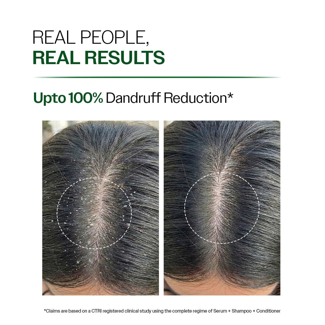 Bare Anatomy Anti Dandruff Shampoo & Hair Conditioner Combo | Helps Manage Flakes, Moisturizes & Reduces Frizz | 250 ml + 175 gm