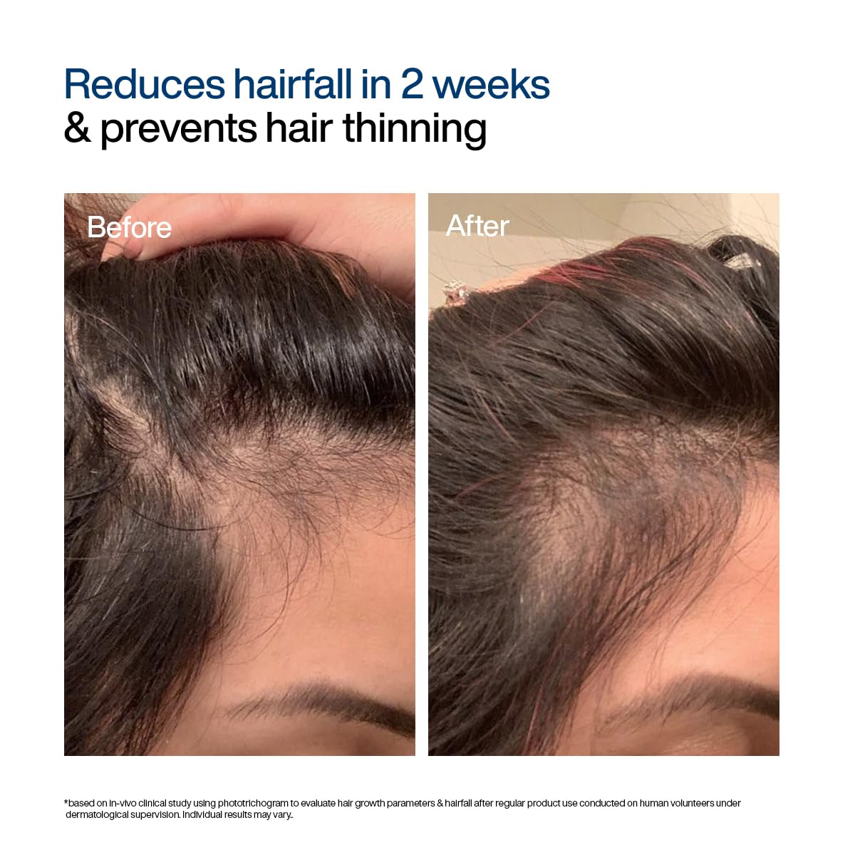 WishCare Hair Growth Serum Roll On For Scalp | 94% Saw New Hair Growth | Redensyl & Rosemary Oil | 100% Saw Hairfall Reduction | In-Vivo Tested | For Men & Women | 10ml