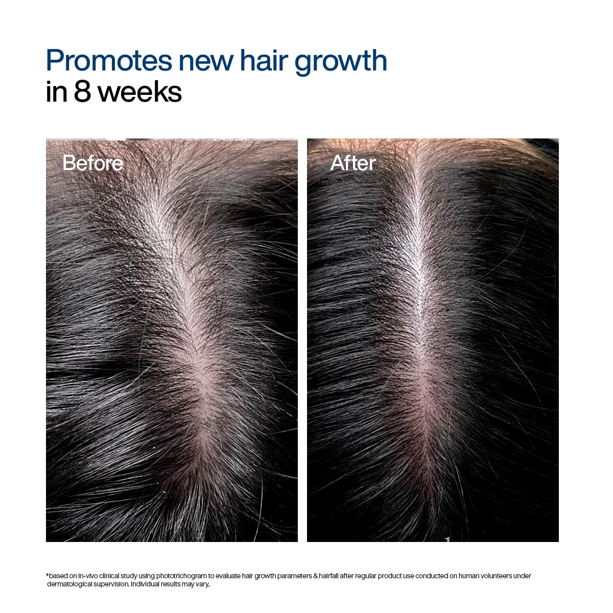 WishCare Hair Growth Serum For Scalp | 94% Saw New Hair Growth | Redensyl & Rosemary Oil | 100% Saw Hairfall Reduction | In-Vivo Tested | For Men & Women | 30ml