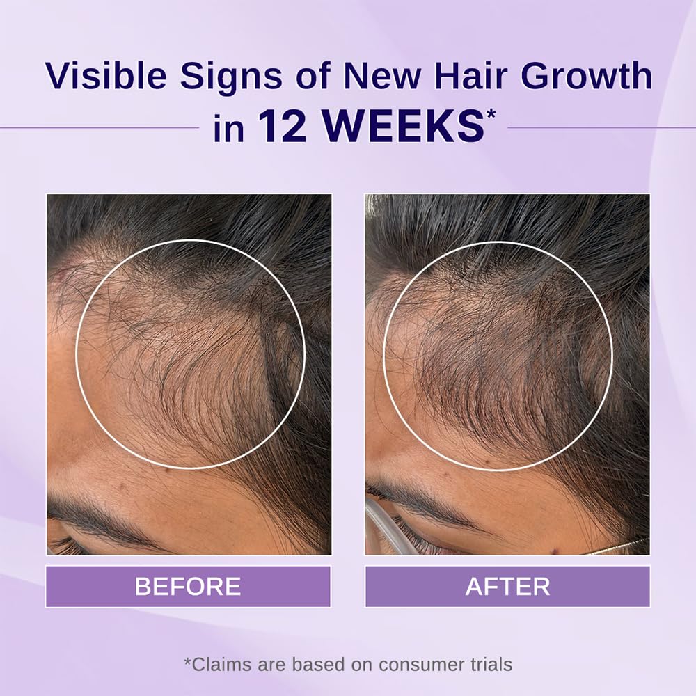 Bare Anatomy Nature x Science Rosemary Hibiscus Hair Growth Oil for Women & Men | Promotes New Hair Growth & Strengthens Hair | Nourishes Scalp & Controls Hair Fall | Suitable for All Hair Types-100ml