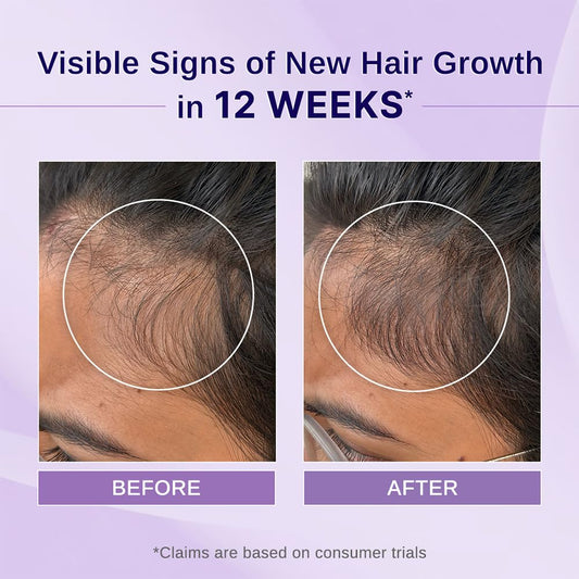 Bare Anatomy Nature x Science Rosemary Hibiscus Hair Growth Oil for Women & Men | Promotes New Hair Growth & Strengthens Hair | Nourishes Scalp & Controls Hair Fall | Suitable for All Hair Types-100ml