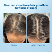 Be Bodywise Rosemary Hair Growth Roll-On Serum (25Ml) & Derma Roller,3% Redensyl,2% Aminexil & 2% Anagain For Thicker Hair Growth,0.5Mm Titanium Micro Needles For Better Follicle Stimulation - Grams