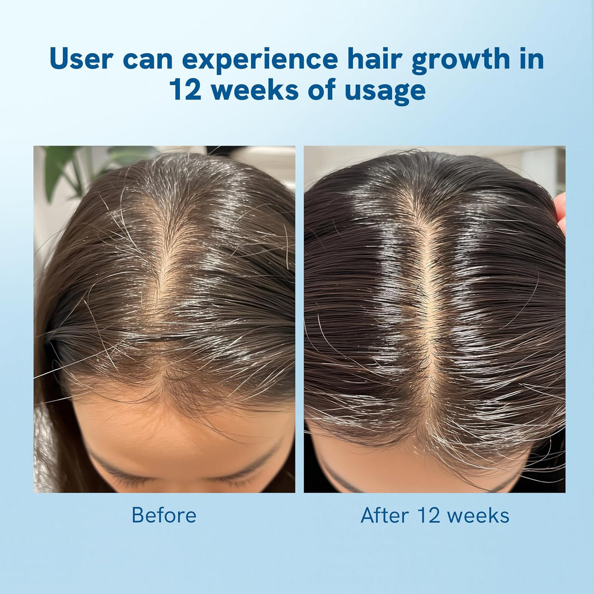 Be Bodywise Rosemary Hair Growth Roll-On Serum (25Ml) & Derma Roller,3% Redensyl,2% Aminexil & 2% Anagain For Thicker Hair Growth,0.5Mm Titanium Micro Needles For Better Follicle Stimulation - Grams